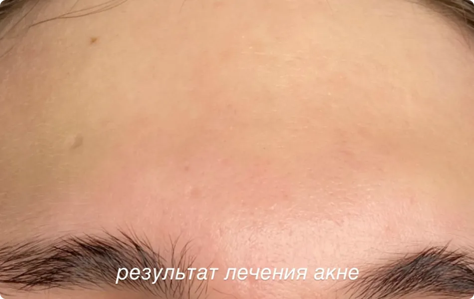 Фото после процедуры: Пример кейса до-после для процедуры "Микротоковая терапия" в клинике "KRASHE" (врач Виктория Выучейская).